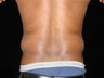 Liposuction of Abdomen, Waist, Flanks with 6 Pack Abdominal Etching