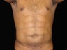 Liposuction of Abdomen, Waist, Flanks, Pecs with 6 Pack Abdominal Etching
