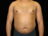 Liposuction of Abdomen, Waist, Flanks, Pecs with 6 Pack Abdominal Etching
