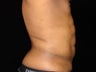 Liposuction of Abdomen, Waist, Flanks, Pecs, with 6 Pack Etching