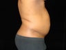 Liposuction of Abdomen, Waist, Flanks, Pecs, with 6 Pack Etching