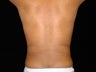 Liposuction of Abdomen, Waist, Flanks, Pecs with 6 Pack Abdominal Etching