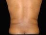 Liposuction of Abdomen, Waist, Flanks, Pecs with 6 Pack Abdominal Etching