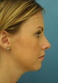 Rhinoplasty
