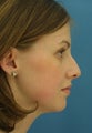 Rhinoplasty