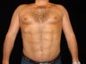 Liposuction of Abdomen, Waist, Flanks, Pecs, and 6 Pack Abdominal Etching