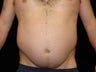 Liposuction of Abdomen, Waist, Flanks, Pecs, and 6 Pack Abdominal Etching