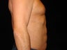 Liposuction of Abdomen, Waist, Flanks, Pecs and 6 Pack Abdominal Etching