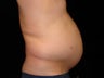 Liposuction of Abdomen, Waist, Flanks, Pecs and 6 Pack Abdominal Etching