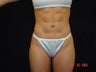 Liposuction Abdomen, Waist, Flanks, Outer Thighs with 6 Pack Abdominal Etching