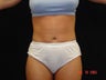 Liposuction Abdomen, Waist, Flanks, Outer Thighs with 6 Pack Abdominal Etching