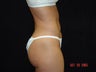 Liposuction of Abdomen, Waist, Flanks, Outer Thighs with 6 Pack Abdominal Etching