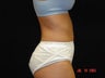 Liposuction of Abdomen, Waist, Flanks, Outer Thighs with 6 Pack Abdominal Etching