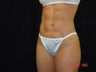 Liposuction of Abdomen, Waist, Flanks, Outer Thighs, with 6 Pack Abdominal Etching