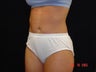 Liposuction of Abdomen, Waist, Flanks, Outer Thighs, with 6 Pack Abdominal Etching