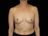 Bilateral Breast Augmentation with Silicone Implants: R-400cc L-450cc