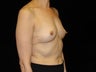 Bilateral Breast Augmentation with Silicone Implants: R-400cc L-450cc