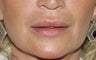 Lip Augmentation