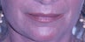 Lip Augmentation