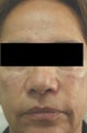 Cheek Shaping with Juvederm Los Angeles Before and After Photos