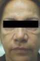 Cheek Shaping with Juvederm Los Angeles Before and After Photos