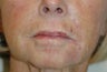 Juvederm for Smile Lines Long Beach, CA Before and After Pictures