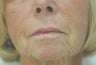 Juvederm for Smile Lines Long Beach, CA Before and After Pictures