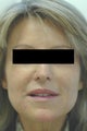Laugh Lines with Juvederm in Anaheim, CA