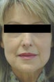 Laugh Lines with Juvederm in Anaheim, CA