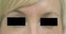 Bags under eyes before and after pictures Juvederm