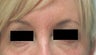 Bags under eyes before and after pictures Juvederm