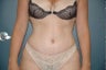 Tummy tuck