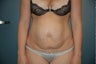 Tummy tuck