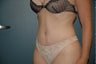 Tummy tuck
