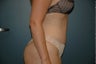 Tummy tuck