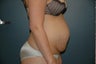 Tummy tuck