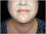 Facial/Submental Liposuction