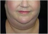 Facial/Submental Liposuction