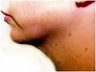 Liposuction - Submental Area/Jawline