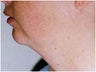 Liposuction - Submental Area/Jawline