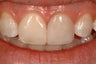 Composite Resin Bonding