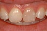Composite Resin Bonding
