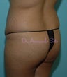 Brazilian Butt Lift