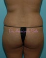 Brazilian Butt Lift