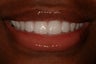Durathin Veneers