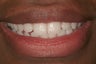 Durathin Veneers