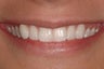 Porcelain Veneers