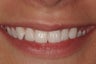 Porcelain Veneers
