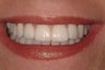 Porcelain Veneers and Crown