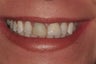 Porcelain Veneers and Crown